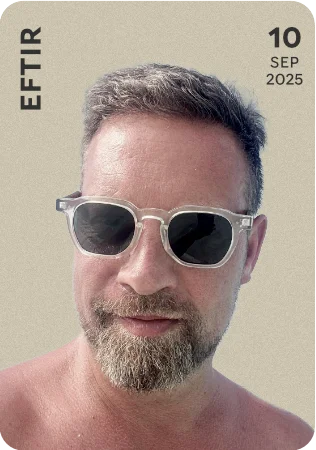 Baldur Rafn - Gefur Ráðgjöf - mynd eftir hárígræðslu