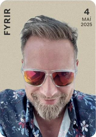 Baldur Rafn - Gefur Ráðgjöf - mynd fyrir hárígræðslu