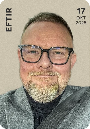 Einar Bárðar - Gefur Ráðgjöf - mynd eftir hárígræðslu